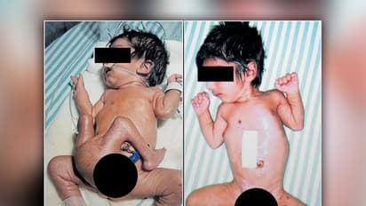 Normal again: Bengaluru hospital restores boy with four legs