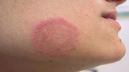 Ring worm: படர்தாமரையால் அவதிப்படுபவரா நீங்கள்? இந்த ஒரு பேஸ்ட் போதும் உடனடி நிவாரணம் கிடைக்கும்!