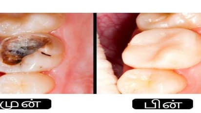 சொத்தைப் பல்லுக்கு இனி டாக்டரை பார்க்க வேண்டிய அவசியம் இல்லை; இருக்கவே இருக்கு இயற்கை வழி…
