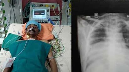 Kerala man lives with two beating hearts after rare transplant