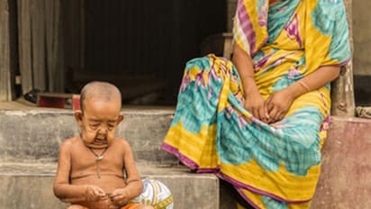 നാല് വയസ് പക്ഷെ എഴുപത് വയസിന്റെ ശരീരവുമായി ഒരു കുട്ടി