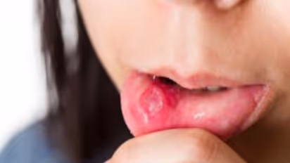 வாய்ப்புண் ஏற்பட என்னவெல்லாம் காரணங்கள் இருக்கு? இதை படிச்சு உஷாரா இருங்க...