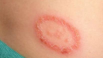 படர்தாமரையை இருந்த இடம் தெரியாமல் ஆக்கும் சில டிப்ஸ் இதோ...