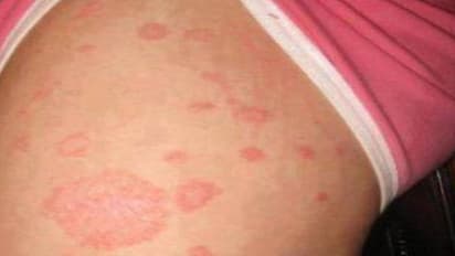 வைரஸ் கிருமியால் வரும் அக்கிநோயை குணமாக்கும் இயற்கை மருத்துவம்!