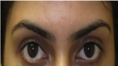 லேடிஸ் அண்ட் ஜென்டில்மேன்...! கண்ணுக்கு கீழே கருவளையமா..? சூப்பர் தீர்வு இதோ....