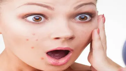 முகப்பரு உங்களை வாட்டி வதைக்குதா..? இதை கொஞ்சம் முயற்சி செய்து பாருங்களேன்..!