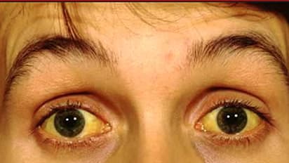 పసుపు పచ్చ లేదా ఎర్రని కళ్లు.. మీ ఆరోగ్యం గురించి ఏం చెప్తాయంటే? 