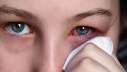 வெயில் காலத்தில் நம்மை படாதபாடு படுத்தும் கண் நோயில் இருந்து விடுபட இதோ சூப்பர் வழிகள்...