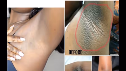 ಡಾರ್ಕ್ ಅಂಡರ್ ಆರ್ಮ್‌ಗೆ ಇಲ್ಲಿವೆ ನೋಡಿ ಮ್ಯಾಜಿಕಲ್ ಹೋಂ ರೆಮಿಡೀಸ್