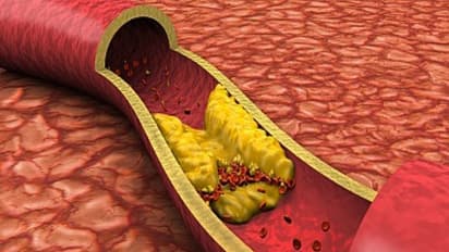 இதற்கு பதில் தெரியுமா? இரத்த குழாய்களில் தேங்கியுள்ள கொழுப்பை கரைக்க உதவுவது எது? 