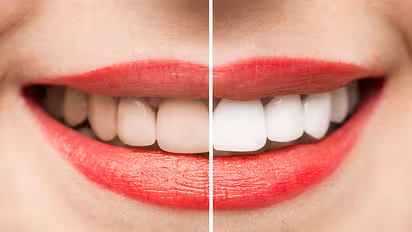 5 teeth-whitening hacks that you can do at home