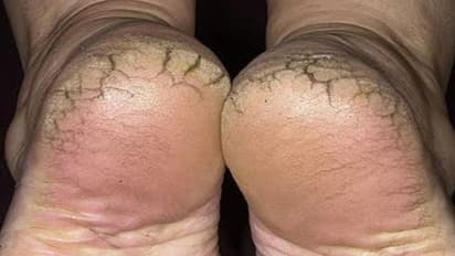 ಒಡೆದ ಪಾದ ಮುಖದ ಅಂದಕ್ಕೆ ದೃಷ್ಟಿ ಬೊಟ್ಟು...!