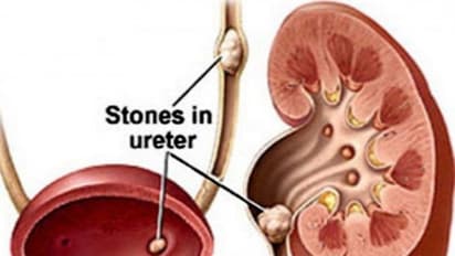 கிட்னியில் கல் வராமல் இருக்க நிறைய காய்கறிகளை சாப்பிடுங்கள் அது போதும்...