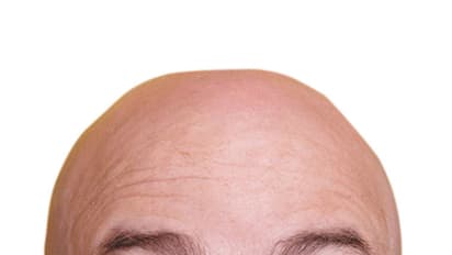 ಬೋಳು ತಲೆ ಸಮಸ್ಯೆಯೇ? ಈ ಗ್ರಹವನ್ನು ಶಾಂತಗೊಳಿಸಿ ನೋಡಿ, ಕೂದಲು ಉದುರೋದು ನಿಂತೀತು!