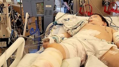 എട്ട് വയസുകാരന്റെ ജീവനെടുത്ത് മാംസം ഭക്ഷിക്കുന്ന ബാക്ടീരിയ