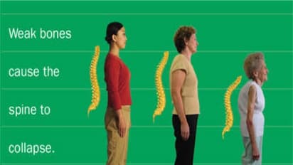 இந்த டிப்ஸ் பெண்களுக்காக! எலும்பு வீக்க நோயை இவற்றின்மூலம் தடுக்கலாம்...