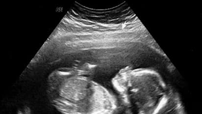 6 ವರ್ಷದ ಕಂದಮ್ಮನ ಹೊಟ್ಟೆಯಲ್ಲಿ ಪತ್ತೆಯಾಯಿತು ಸತ್ತ ಭ್ರೂಣ!