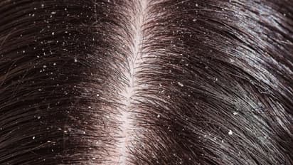 எளிதான இந்த வழிமுறைகளை பின்பற்றி பொடுகை விரட்டலாம்...