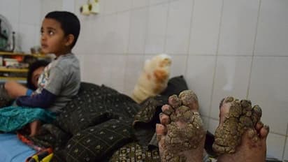 'ಟ್ರೀ ಮ್ಯಾನ್' ಎಂದೇ ಪರಿಚಿತನಾಗಿರುವ ಈ ವ್ಯಕ್ತಿಗೆ ವಿಚಿತ್ರ ರೋಗ; ವೈದ್ಯಲೋಕಕ್ಕೆ ಸವಾಲು