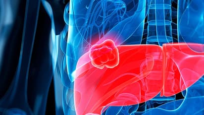 നിങ്ങളുടെ കരള് അപകടത്തിലാണ്- 5 പ്രാരംഭ ലക്ഷണങ്ങള് ശ്രദ്ധിക്കൂ...