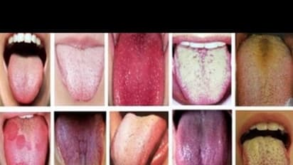 நாக்கின் நிறத்தை வைத்தே உங்கள் ஆரோக்கியத்தின் அளவை அறியலாம். எப்படி?