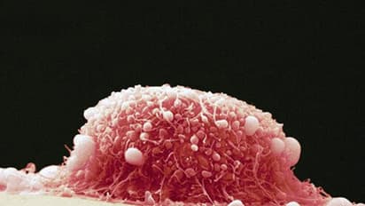 'രാജ്യത്ത് വർഷത്തിൽ 70,000ത്തിലധികം പേരുടെ മരണത്തിന് കാരണം'; രോഗത്തെ ചെറുക്കാൻ ലക്ഷ്യമിട്ട് കേരളം, വാക്സിനേഷൻ