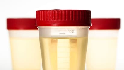 ಮೂತ್ರದ ಬಣ್ಣದಲ್ಲಿದೆ ಆರೋಗ್ಯದ ಗುಟ್ಟು