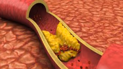 இரத்த குழாய் அடைப்பை போகும் ஒரு அருமருந்து இதோ…