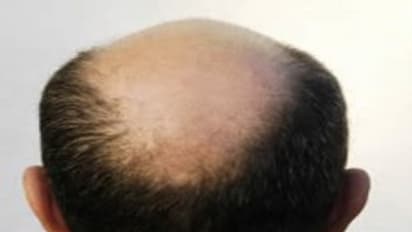 வழுக்கை தலையிலும் முடியை வளரச் செய்யலாம்... இந்த விஷயத்தை தவறாமல் செய்தால்...