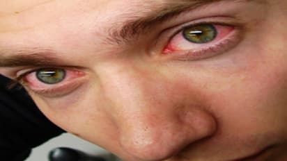 கண் சிவப்பதற்கு மதுவும் ஒரு காரணம் என்று நீங்கள் அறிவீர்களா?