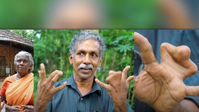 'Curse of snake Gods': Kerala family, with webbed fingers, refuses surgery [Video]