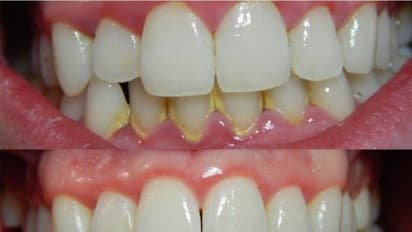 ದಂತಪಂಕ್ತಿ ಮೂಗಿನಲ್ಲಿ...20 ವರ್ಷದಿಂದ ಗೊತ್ತೆ ಆಗ್ಲಿಲ್ಲ!