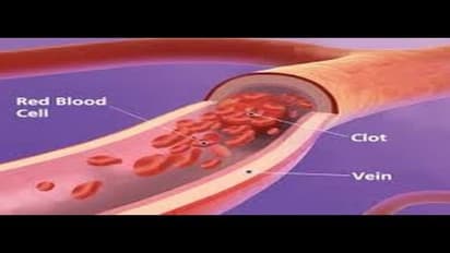 இரத்த குழாய் அடைப்பு நீங்க இந்த பானத்தை குடியுங்கள்…