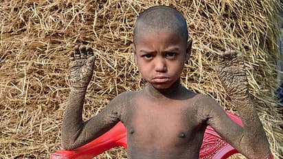 കല്ലായി മാറിക്കൊണ്ടിരിക്കുന്ന എട്ടു വയസ്സുകാരന്‍; ഞെട്ടിക്കുന്ന വീഡീയോ