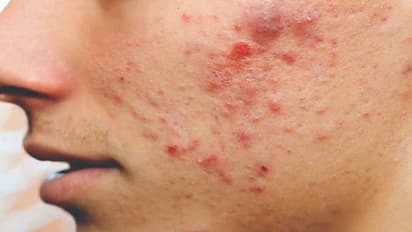 முகப்பருக்களால் வெளியில் தலை காட்ட முடியலையா? அப்போ இந்த டிப்ஸ் உங்களுக்கு…