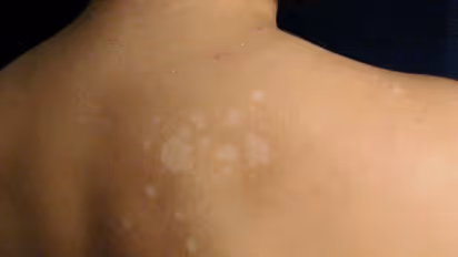 உடலில் அசிங்கமாக தெரியும் தேமல் மறைய இதை செய்து பாருங்களேன்...