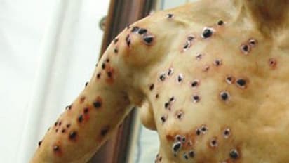 ബ്യൂബോണിക്ക് പ്ലേഗ് ആശങ്ക; വില്ലന് അണ്ണാറക്കണ്ണന്