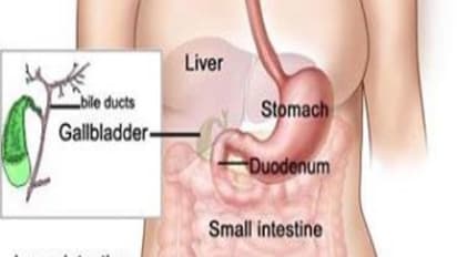 பித்தகற்களை போக்க இந்த மூன்று பொருட்களையும் ஒன்றாக சாப்பிட்டாலே போதும்...