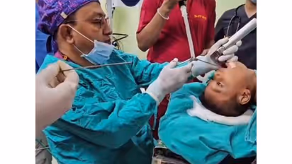 Doctors at AGMC, Agartala, remove coin from a four-year-old boy’s food pipe (Photo: AGMC & GBP Hospital)