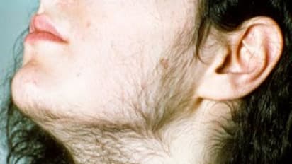 ஐந்து நிமிடத்தில் முகத்தில் உள்ள சிறு ரோமங்களை நீக்குவது எப்படி ..?