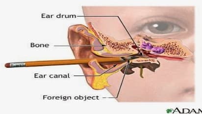 உங்களுக்குத் தெரியுமா? காதுக்குடுமியை அகற்ற நீங்கள் செய்யும் இந்த செயல்கள் உங்கள் காதுக்கு மிகவும் ஆபத்தானது…