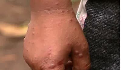 Tomato fever : ഇടുക്കിയില്‍ തക്കാളിപ്പനി വ്യാപിക്കുന്നു; ജാഗ്രത വേണമെന്ന് ആരോഗ്യ വിദഗ്ധര്‍