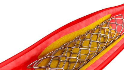 Angioplasty stents cheaper now, but hospitals trick patients to deny benefit