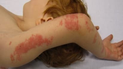 உங்களுக்குத் தெரியுமா? அம்மை நோய் முன்பு தாக்கியவர்களுக்குதான் அக்கி நோய் வருமாம்...