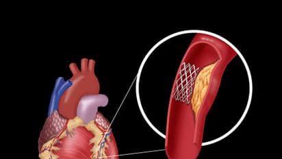 Angioplasty will now cost less, thanks to central government