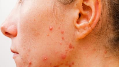 சீழ் நிறைந்த பருக்களை இருந்த இடம் தெரியாமல் போக்க உதவும் வீட்டு வைத்தியங்கள்...