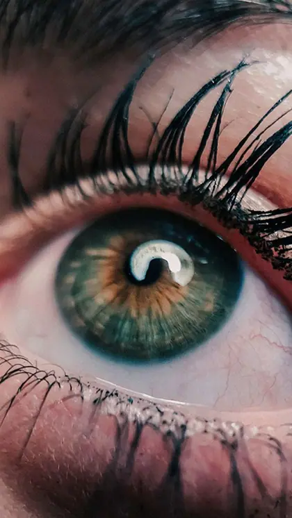 3. Myopia (Nearsightedness)