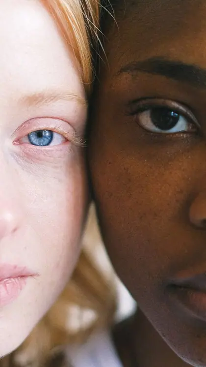 2. Strabismus (Crossed Eyes)