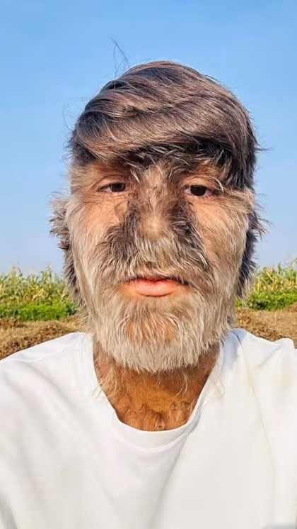 Werewolf Syndrome: Persevering through Challenges and Mockery