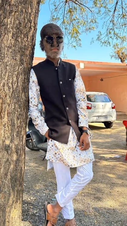 Lalit was diagnosed with the syndrome when he was 6 years old